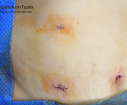 Sự khác biệt giữa phẫu thuật nội soi và mổ mở truyền thống trong phẫu thuật thu nhỏ dạ dày là gì?